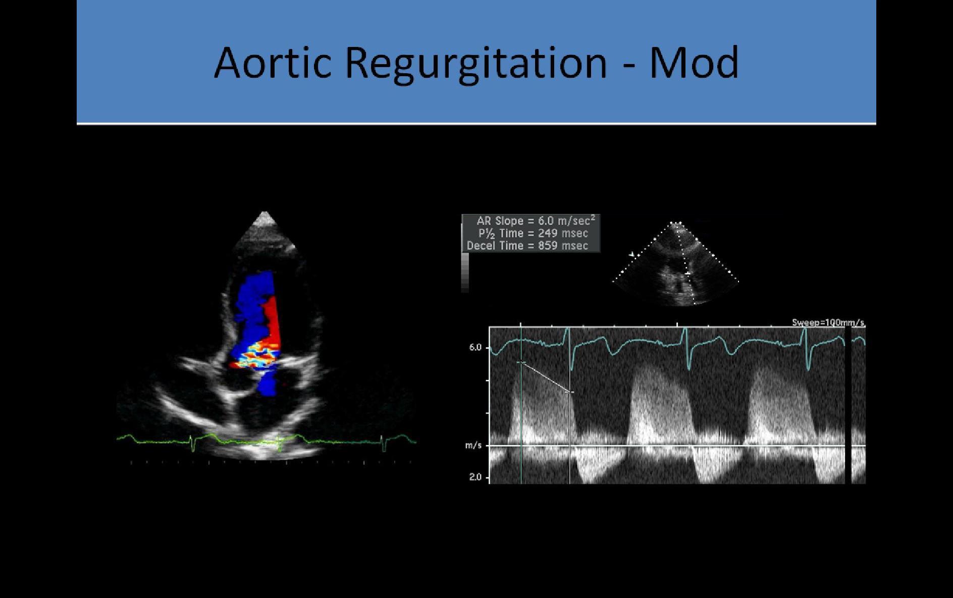 Ultrasound Registry Review - Valvular Abnormalities