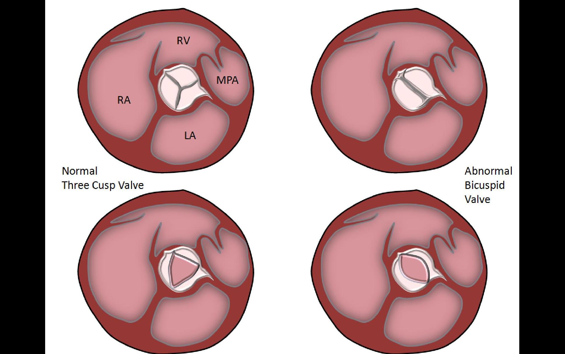 mitral-valve-unicuspid-mitral-valve