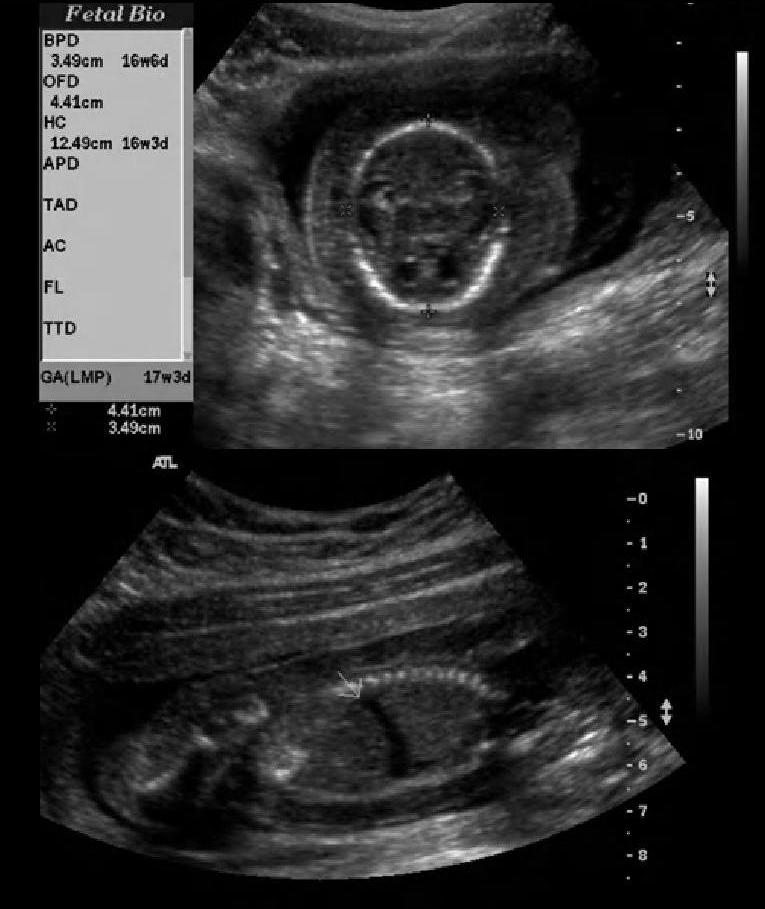 icd 10 code for abnormal ultrasound in pregnancy