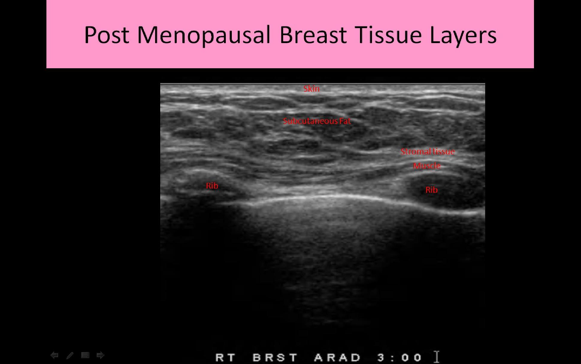 Thoracic wall and breast: normal anatomy