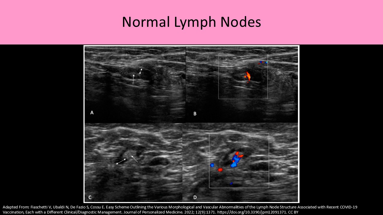 Normal lymph node