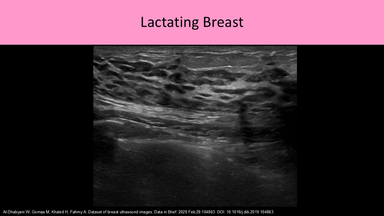 Lactating Breast