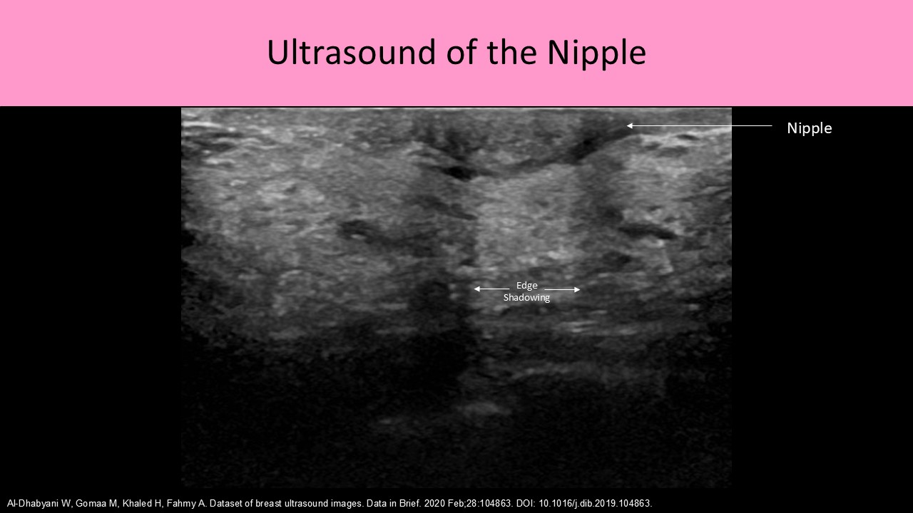 Ultrasound of the Nipple