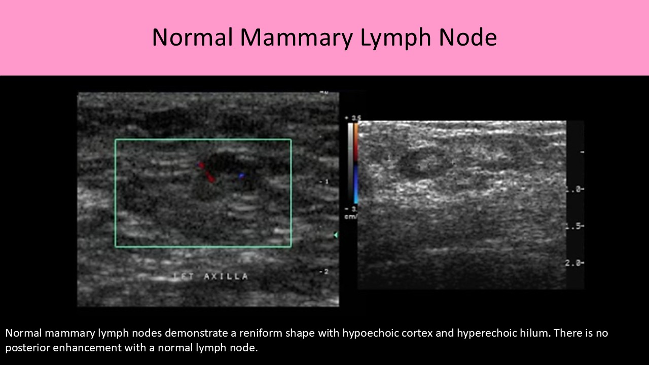 Normal mammary lymph node