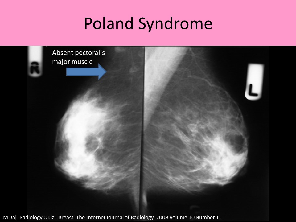 Poland Syndrome