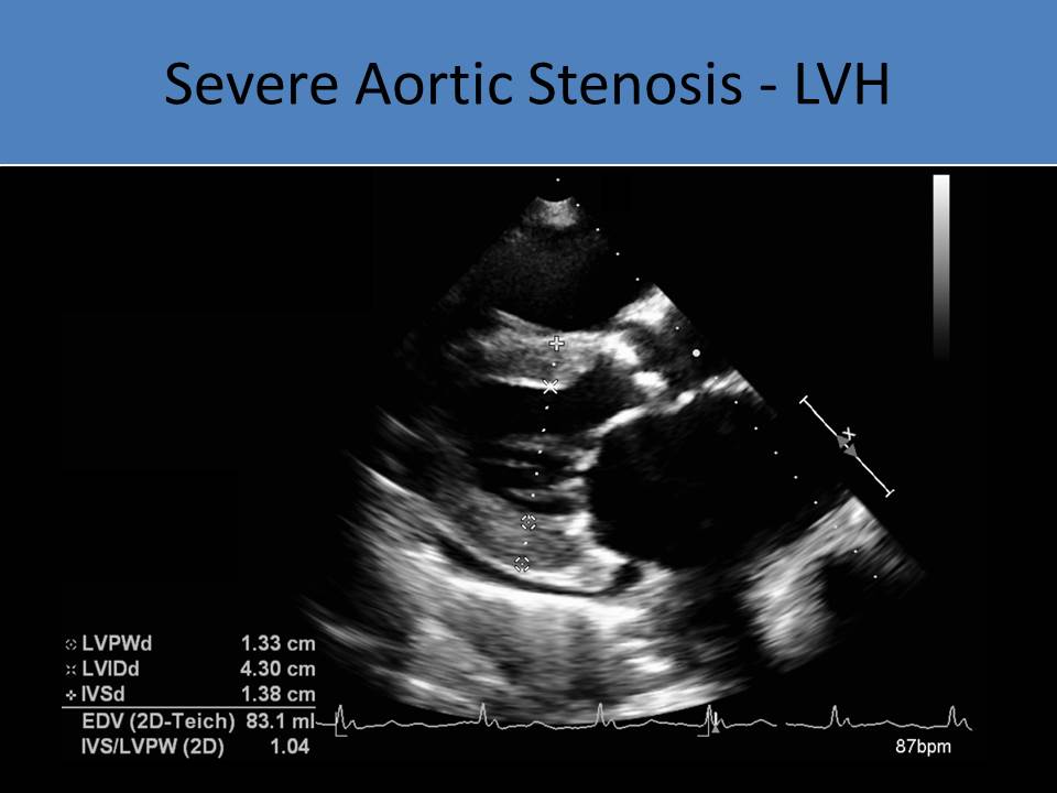 Severe Aortic Stenosis - LVH