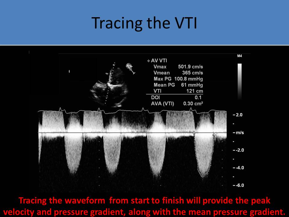 ultrasound-registry-review-aortic-stenosis