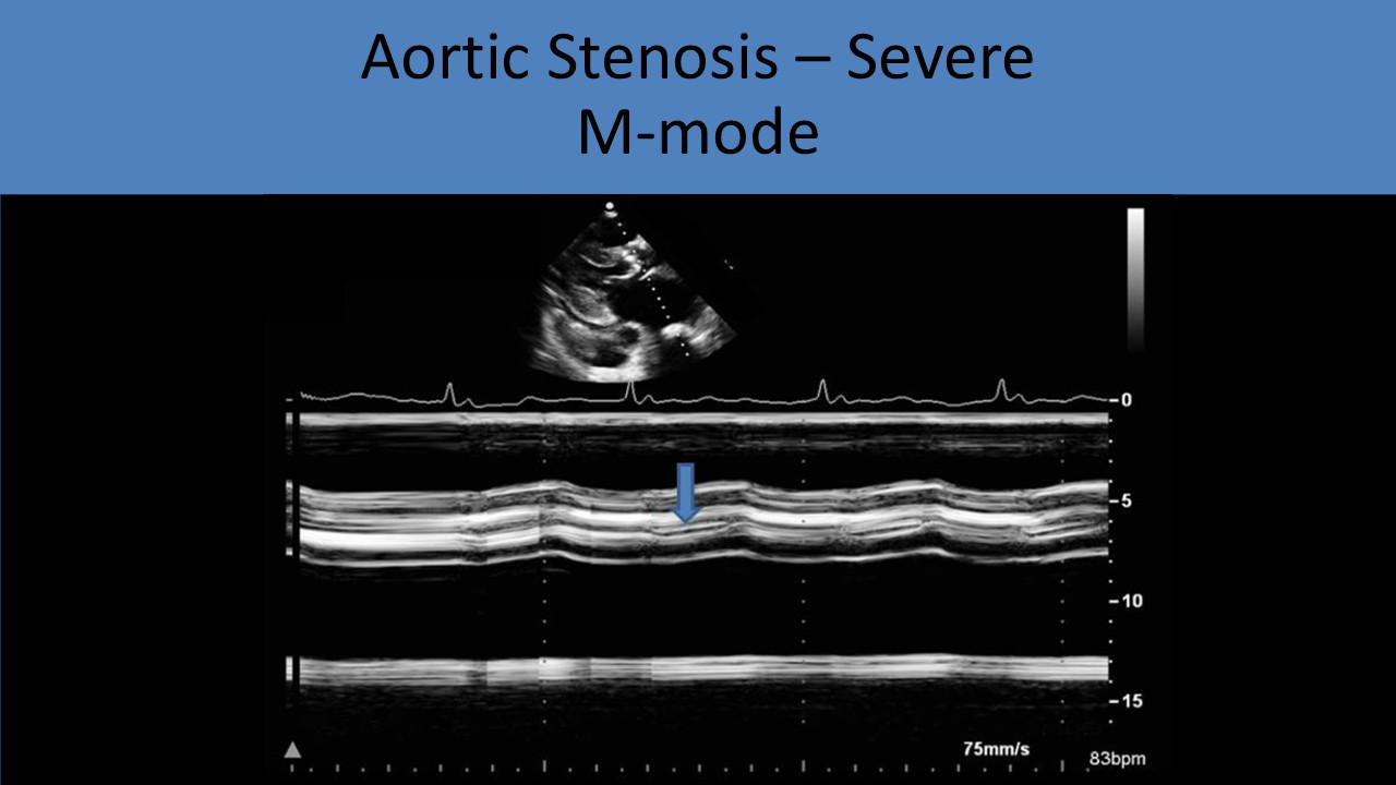 Severe aortic stenosis m-mode