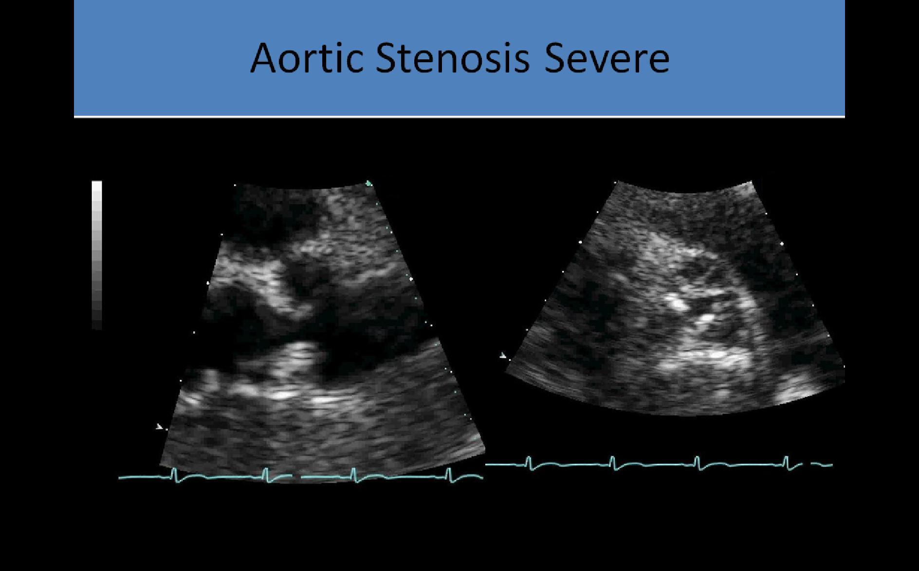 ultrasound-registry-review-aortic-stenosis