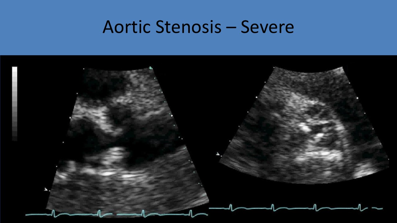 Aortic Stenosis severe