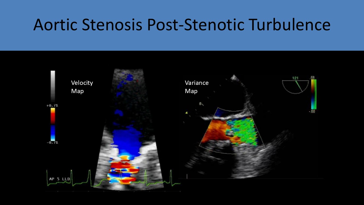 Post-Stenotic Turbulence