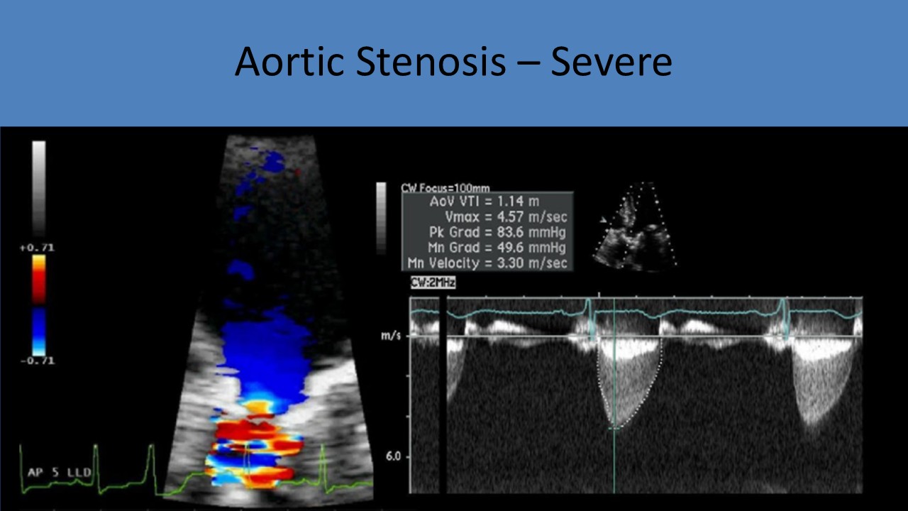 Aortic Stenosis severe