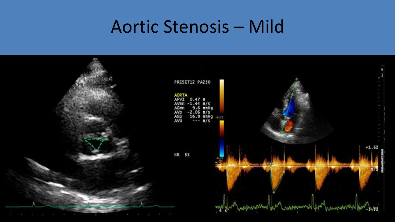 Aortic Stenosis Mild
