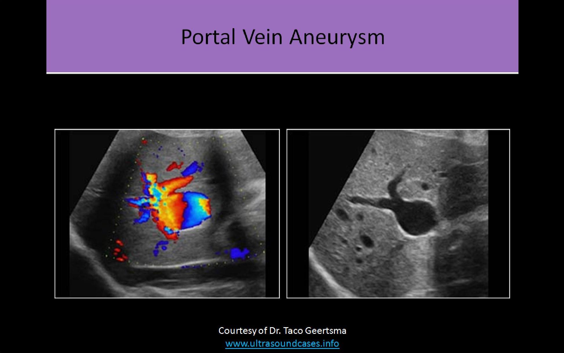 abdominal sonogram