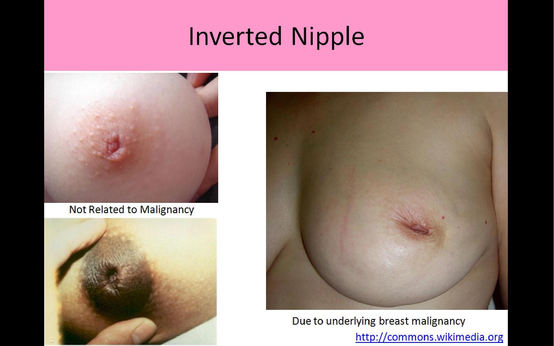 Breast buds pictures