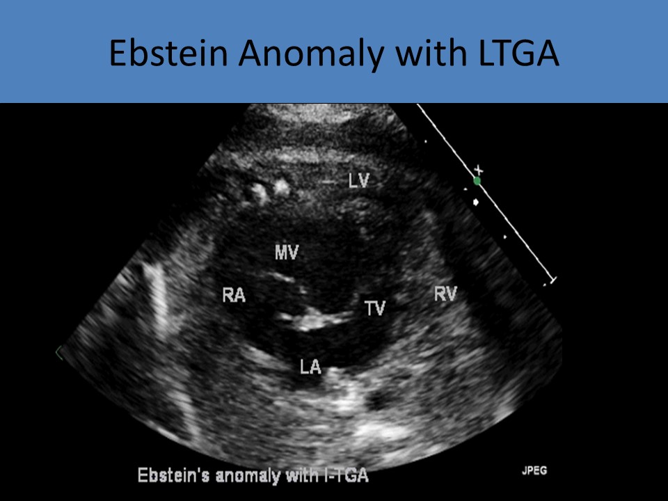 Ebstein Anomaly with LTGA