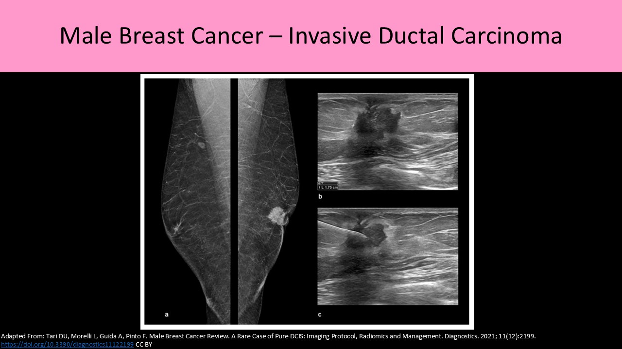 Breast ultrasound image 1