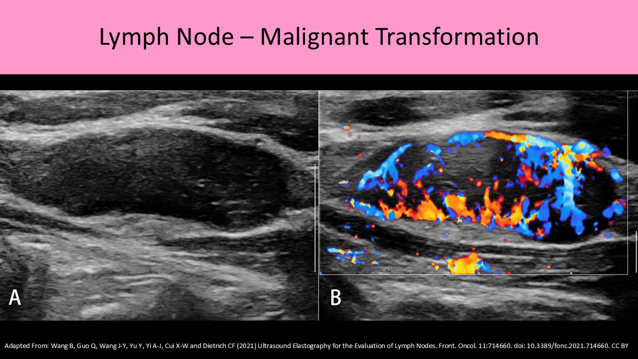 Breast ultrasound image 5