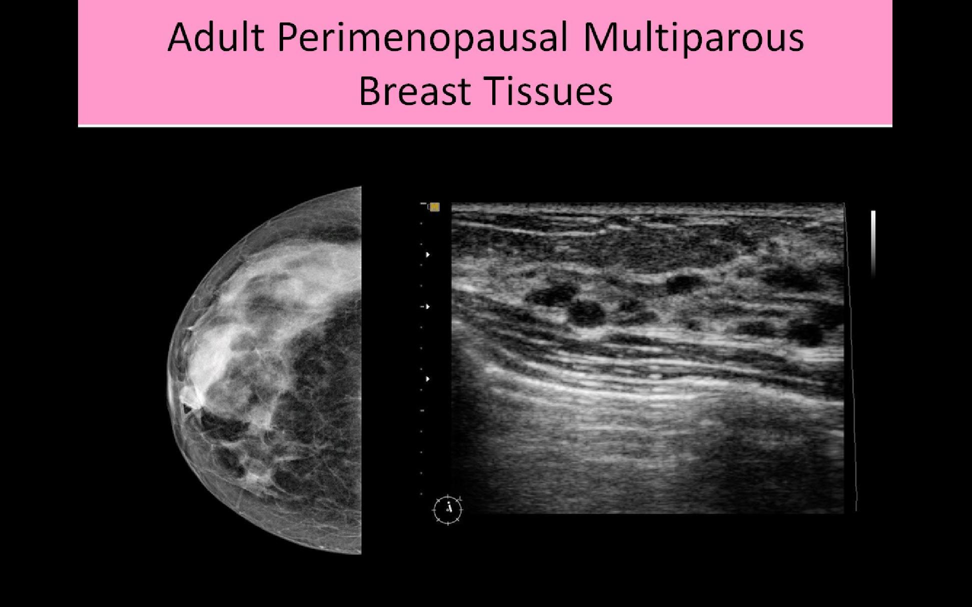 Breast Ultrasound Radiology reference