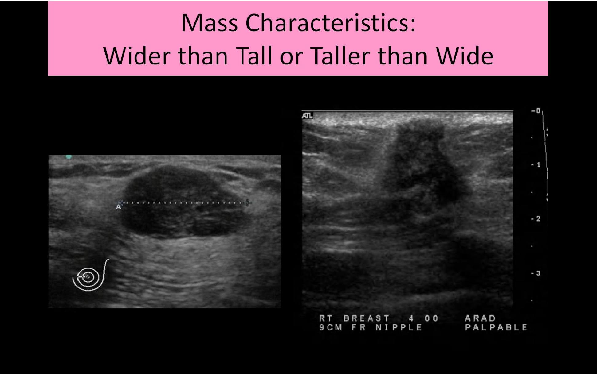 breast sonogram