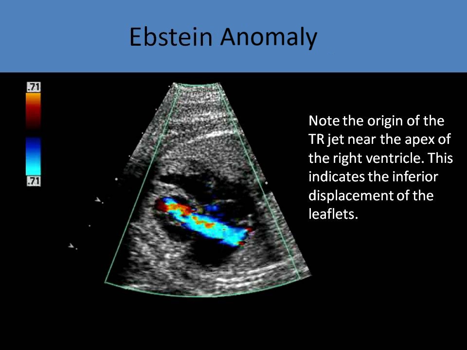 Ebstein Anomaly 3