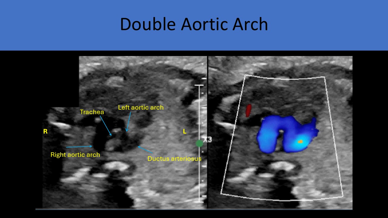 Fetal echocardiography image 2