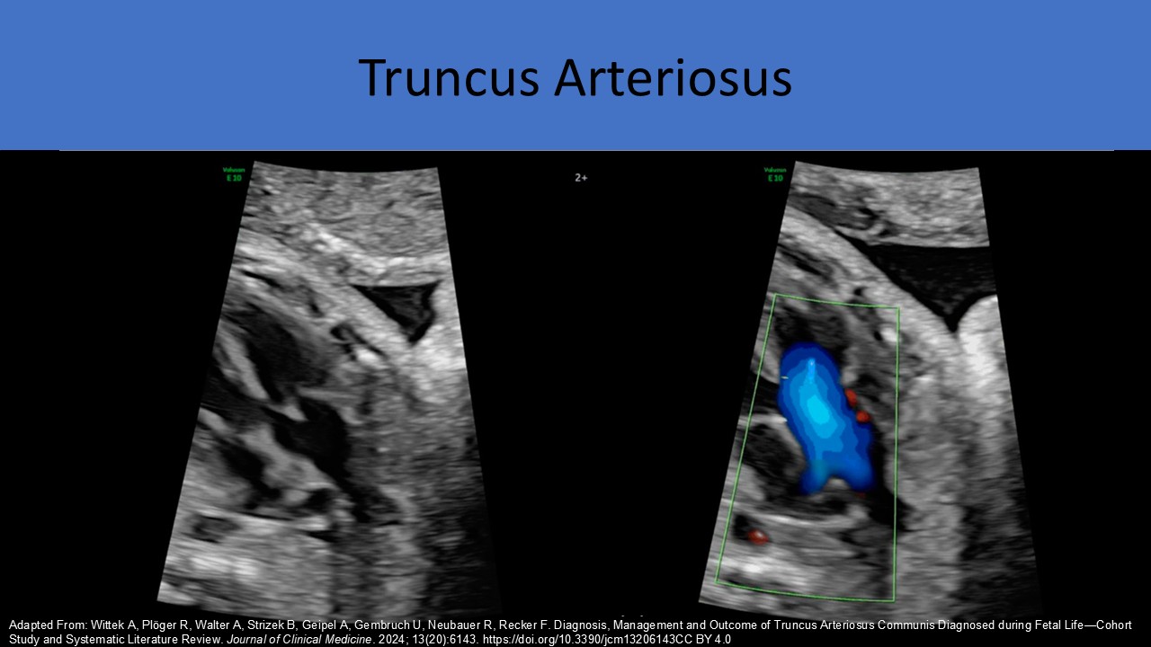 Fetal echocardiography image 6