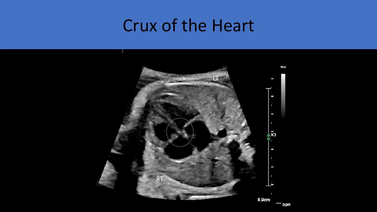 Fetal echocardiography ultrasound image
