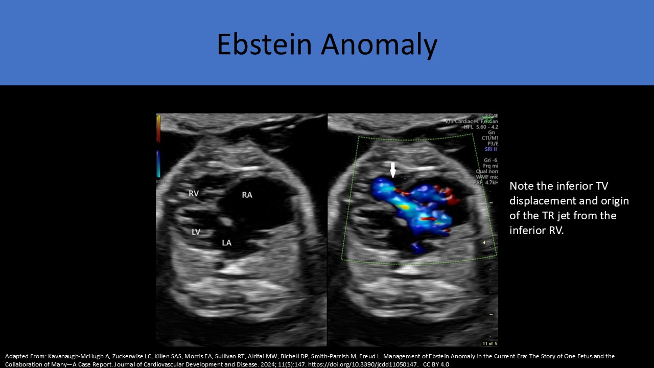 Fetal echocardiography image 7