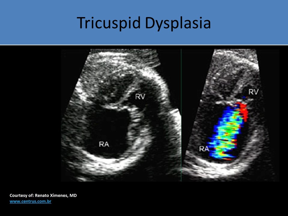 Tricuspid Dysplasia 3