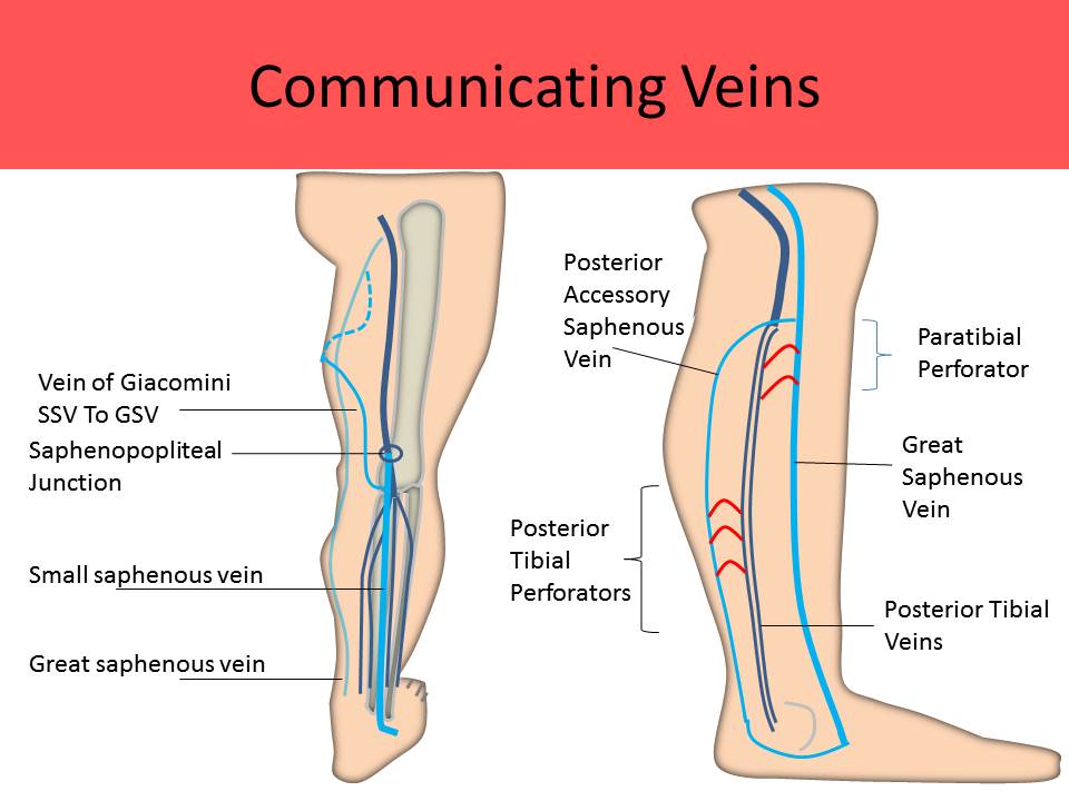 gastrocnemius vein dvt