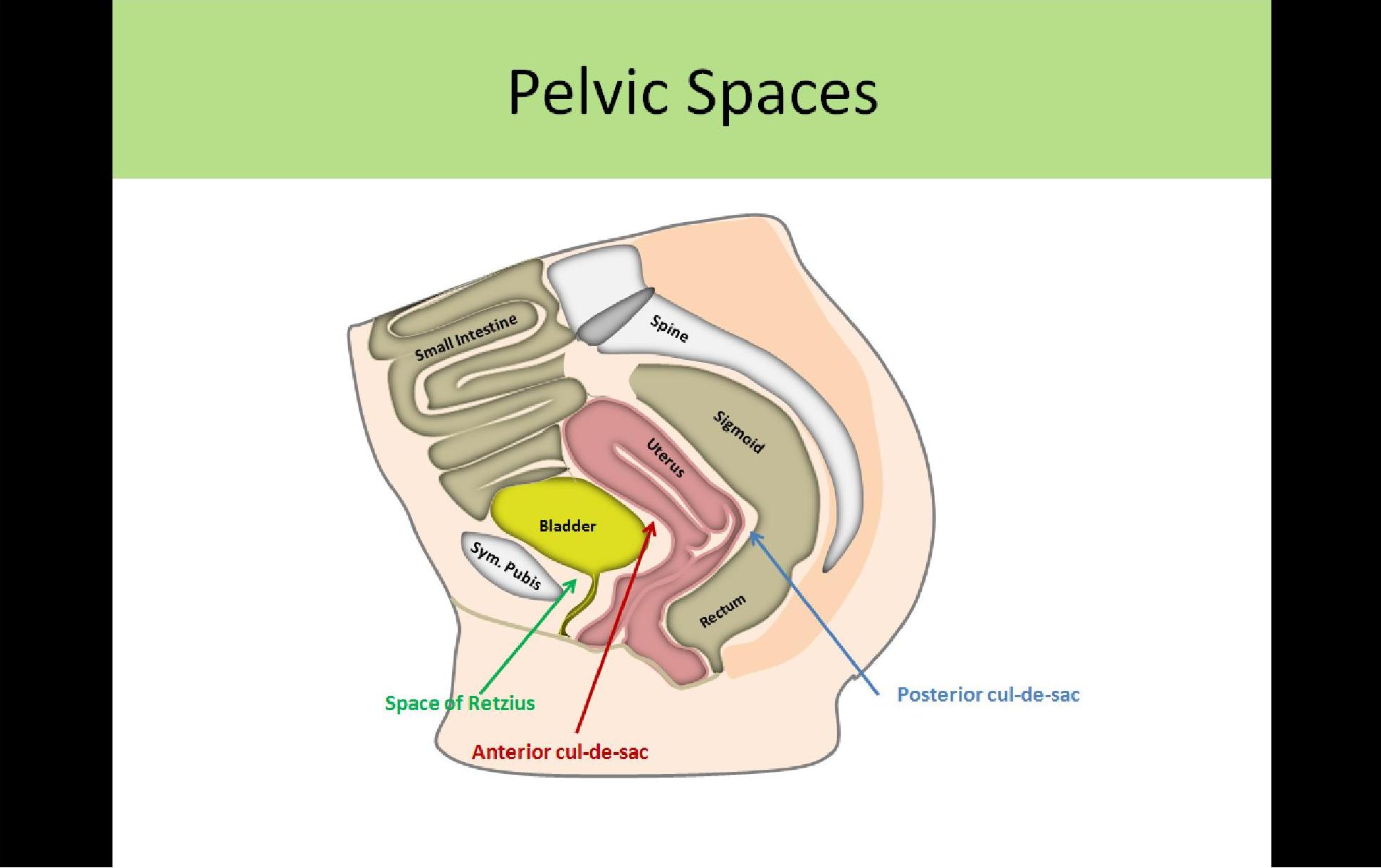 Vesicouterine Pouch