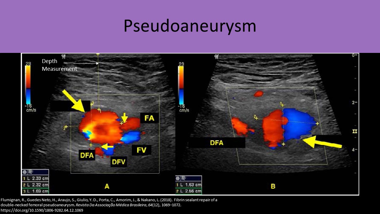 Pseudoaneurysm color doppler