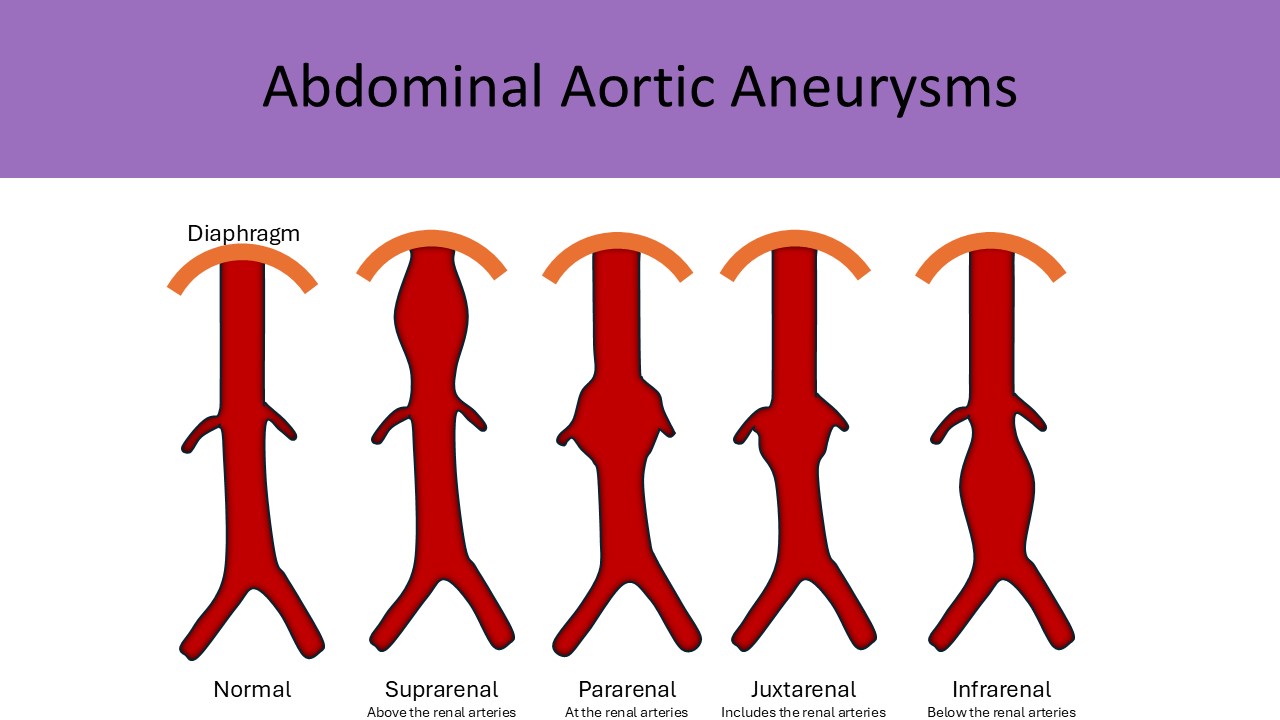 Abdominal aortic aneurysms