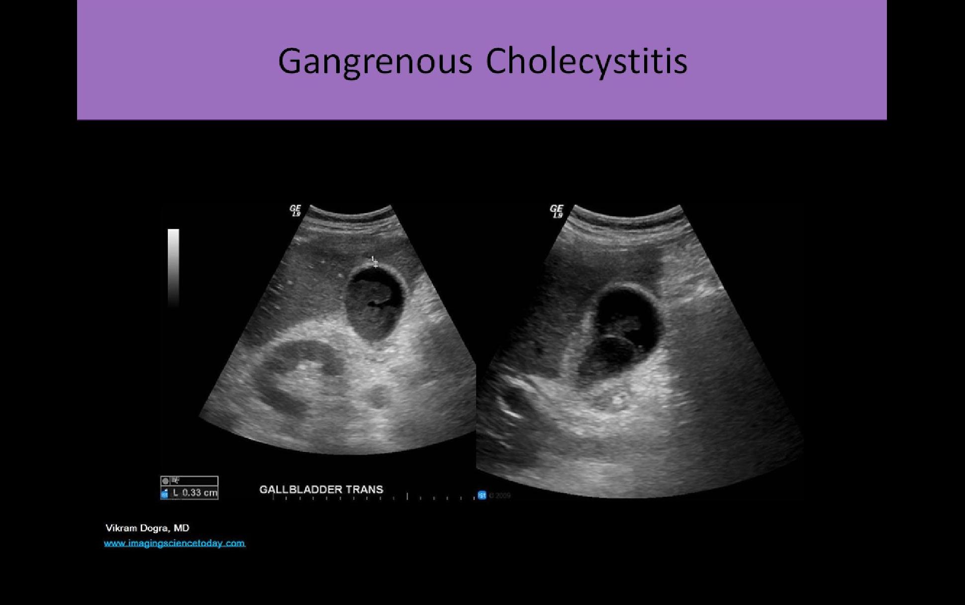 abdominal sonogram